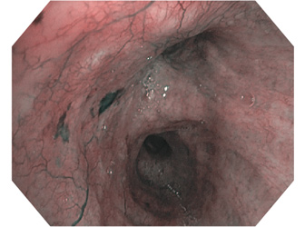 Esophagus* - NBI